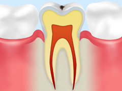 CO：ごく初期のむし歯表面の脱灰