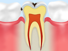 C1：初期のむし歯エナメル質のむし歯