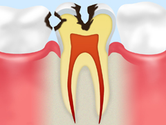 C2：中期のむし歯象牙質に達したむし歯