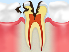 C3：後期のむし歯歯髄に達したむし歯
