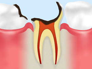C4：重度のむし歯歯冠がほとんど溶かされたむし歯