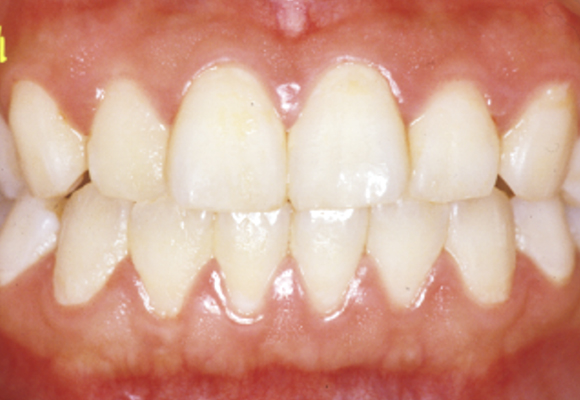 う蝕（むし歯）や歯周病の原因は