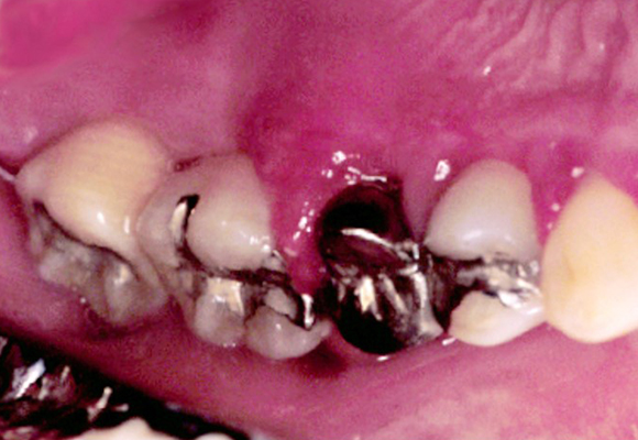 歯周炎（重度の歯周病）