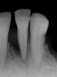 歯周炎（重度の歯周病）<br>リグロス ®を用いた歯周組織再生療法を行った症例