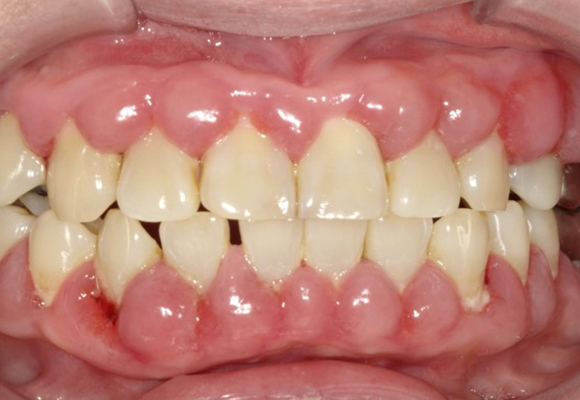 歯周炎（重度の歯周病）、薬物性歯肉増殖症（Ca拮抗薬服用）