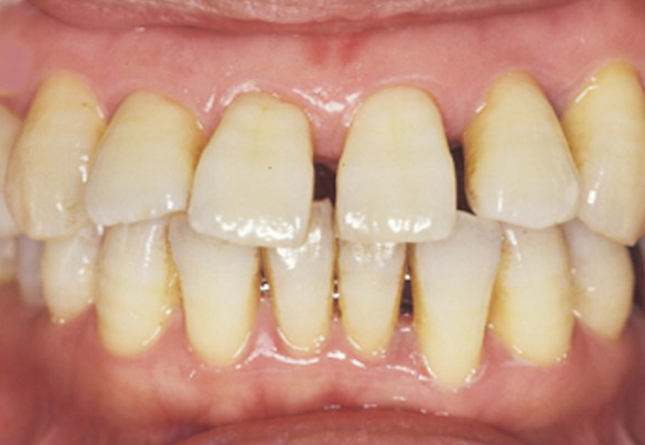 歯周炎（重度の歯周病）、長期メインテナンス