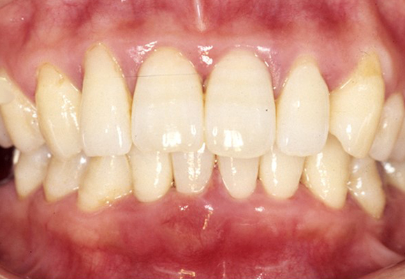 歯周炎（重度の歯周病）、長期メインテナンス