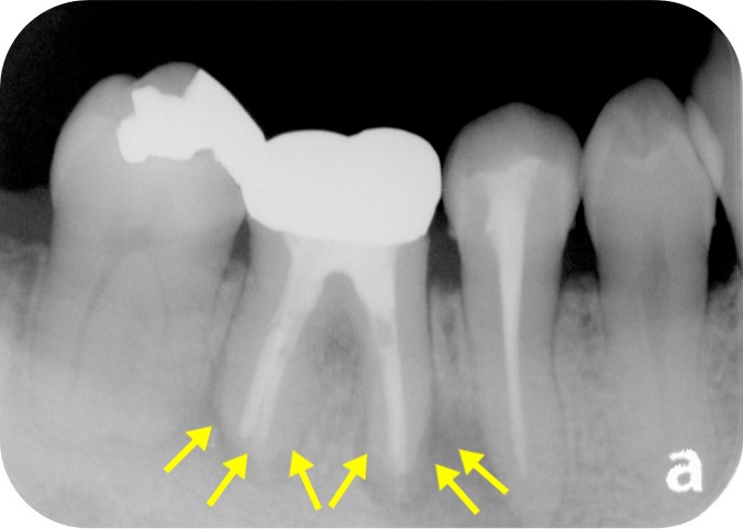 治療後（根管充填後）