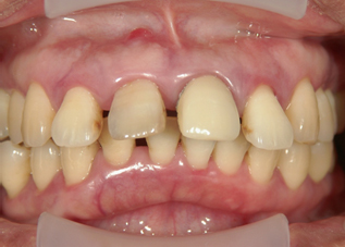 歯周炎（重度の歯周病）、歯の移動