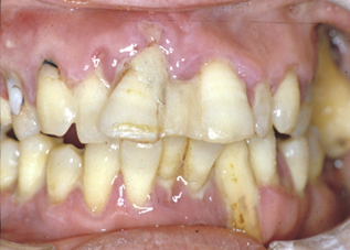 歯周炎（重度の歯周病、抜歯の適応）、歯の移動